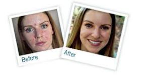 I have my doubts about Proactiv. I think if you need to market on television at 3 am, you probably aren't very good.