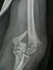 broken bone