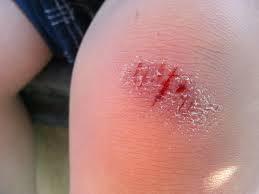 scraped knee