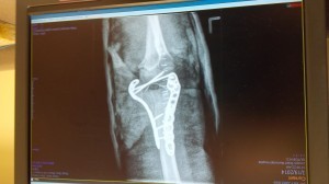 This hardware sets off metal detectors