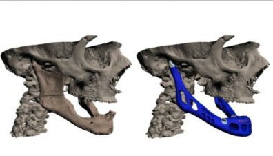 3d-printed-jaw