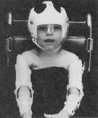 Lesch Nyhan patient with custom helmet and limited motion elbow orthoses.