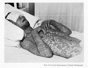 smallpox-victim