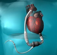Dick Cheney LVAD device