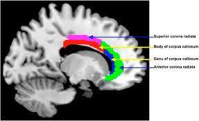 PET brain images meditation 1