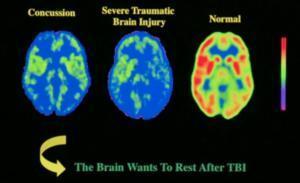 normal severe TBI concussion images