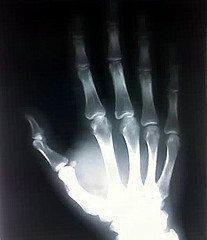 X-ray of a hand