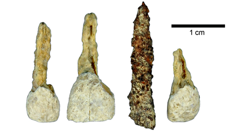 2,300-year-old iron false tooth
