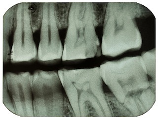 xray