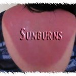 sunburns