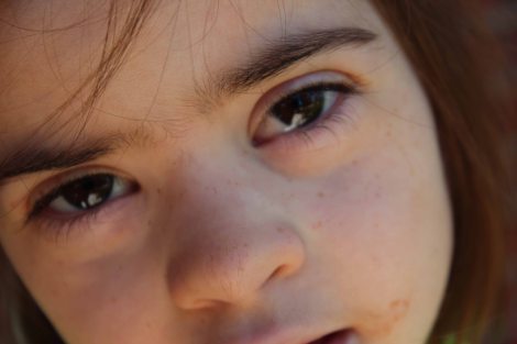 Freckles 1