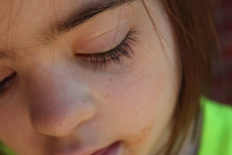 Freckles 2