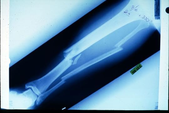 The case for stem cell treatment - original compound fracture of adventurer Jason Lewis's left leg after being run over by a car in Colorado, leading for worn knee cartilage