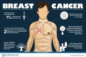 male breast cancer