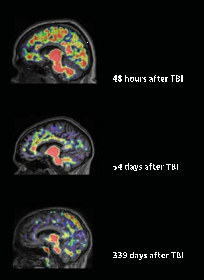 TBI Amyloid Plaque over time