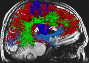 DTI of mild TBI