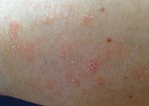 psoriasis