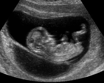 An unborn human at 12 weeks.