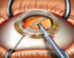 Cataract-surgery-India