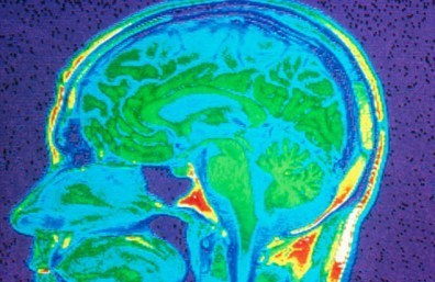 depression_brainscan