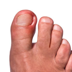 treat-an-ingrown-nail-1