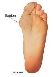 Bunion