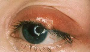 eyelash-infection