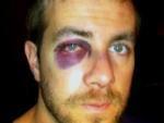 Bartscher's black eye: 