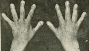 Hands with clubbed thumbs