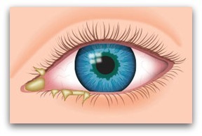 Eye boogers