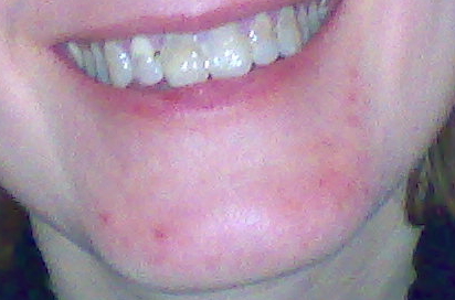 demodex7