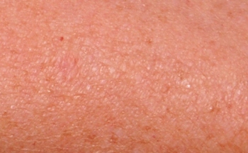 skin-cancer-treatment-day-2-10-05-2014