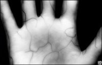 vein-scan-324x205