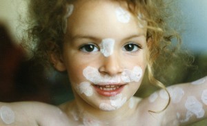 calamine-lotion-for-chicken-pox-776