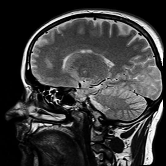 MRI of brain by bykst. Public Domain via Pixabay.