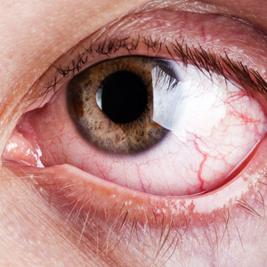 bloodshot