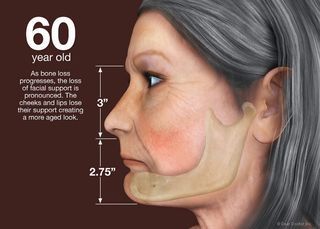 Bone-loss-60-year-old