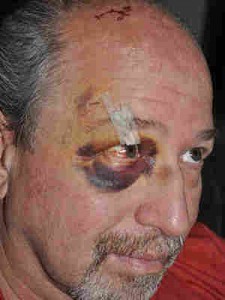 Napa State staffer following an assault