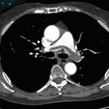 Saddle pulmonary embolism