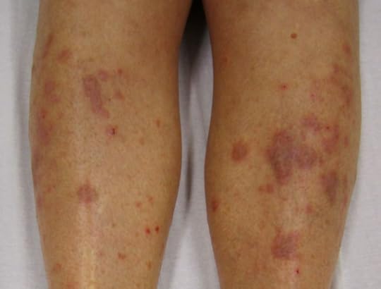 A lichen planus rash, from Wikipedia