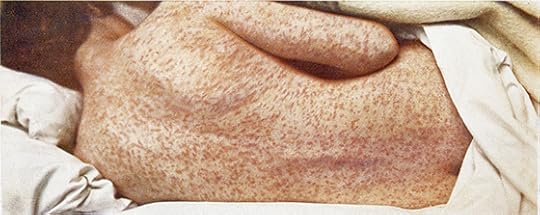 1908 image of measles rash via Wellcome Institute