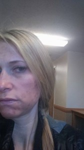 24 hours after Fotofacial 