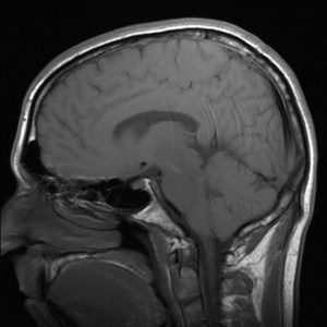 Brain image