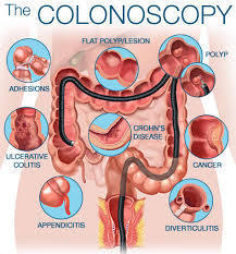 prep crohns diagram