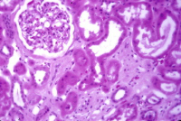 heavy metal toxic nephropathy