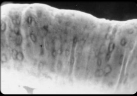 crohns-disease-s7-photo-of-barium-enema-exam-with-aphthous-ulcers
