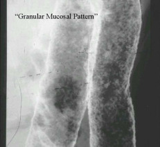 ulcerative_colitis_1