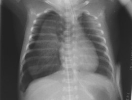 CXR - preterm bilat pneumothoraces