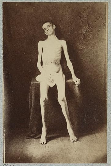 One of the famed photos of emaciated Union prisoners, showing the hardships many of them faced. Although often associated with Andersonville, the majority of these soldiers had been incarcerated at Belle Isle. Research by the NPS has identified this as William Smith of the 8th Kenctucky, who had been captured at Chickamauga (Library of Congress)