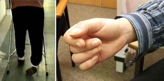 Figure 1. Functional leg weakness and functional hand dystonia are some of the common and disabling symptoms of functional disorders seen in modern neurological practice (courtesy of Neuro Symptoms).